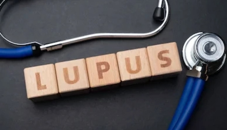 Stres Bisa Picu Kekambuhan Lupus
